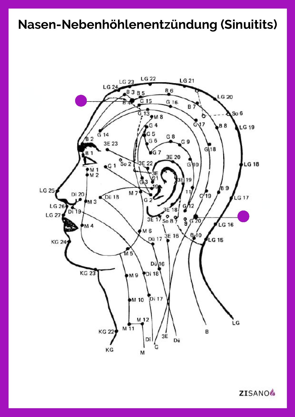Meridiane -Nasen-Nebenhöhlenentzündung - Sinuitis - Beschwerden